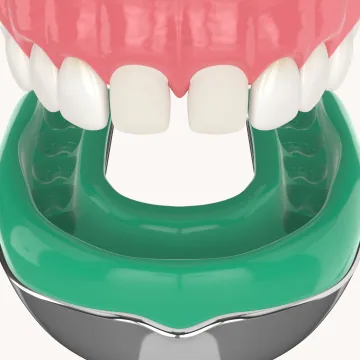 서울디테일치과 발치 및 임플란트 식립