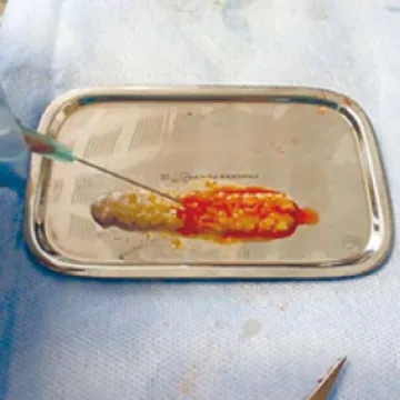 서울디테일치과 채취한 A-PRF를 수술 부위에 맞게 성형